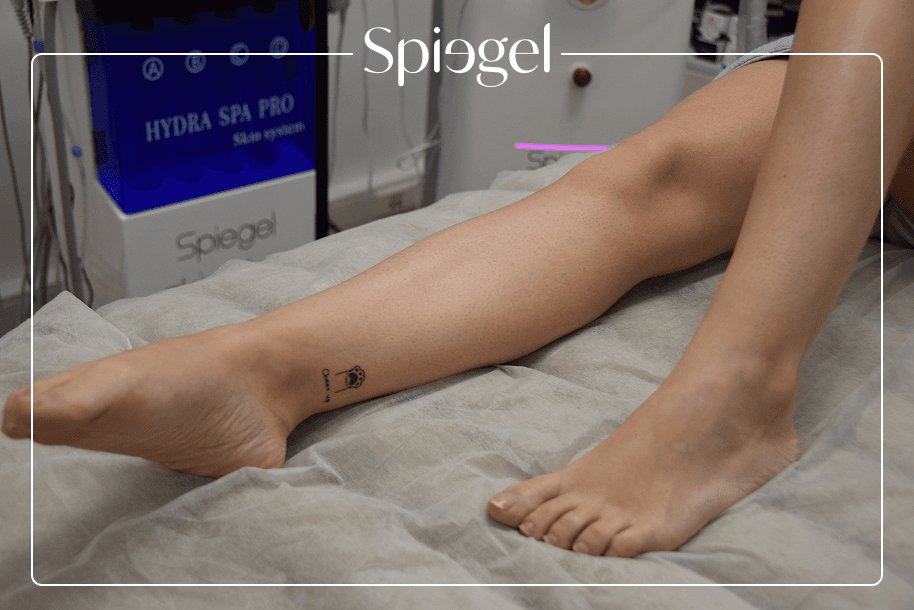 Peau satinée, nette et sans poils après le protocole complet d'épilation laser